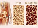 它骨骼强度的主要指标、简单方便、安全靠谱对骨代谢有很重要作用