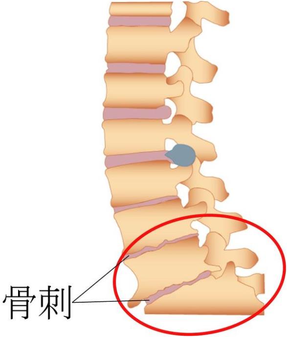 吉林长春|绿巨人视频污版app最新版超声绿巨人视频app黄色官方下载仪厂家品牌分享:为什么现在的年轻人也存在骨刺增生?