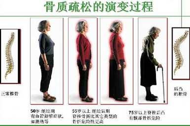 绿巨人视频app黄色官方下载仪生产厂家关于得了骨质疏松如何增加绿巨人视频app黄色官方下载提高骨强度